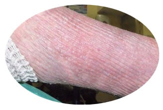 EdemaWear® Stockinet