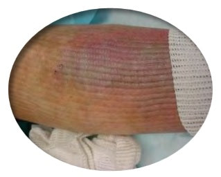 EdemaWear® Stockinet