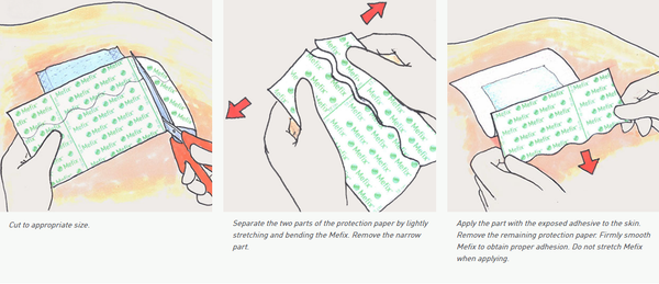 Mefix Adhesive Tape - 10cm x 10m